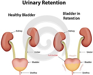 Benign Prostatic Hyperplasia