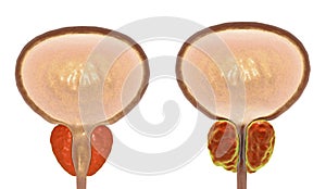 Benign prostatic hyperplasia