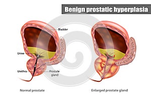 Benign prostatic hyperplasia BPH photo