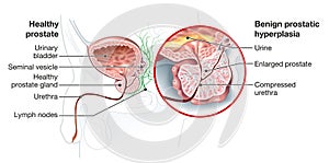 Benign prostatic hyperplasia BPH, enlarged prostate with bladder, urethra and seminal vesicle, medical illustration