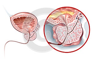 Benign prostatic hyperplasia BPH, enlarged prostate with bladder, urethra and seminal vesicle, medical illustration