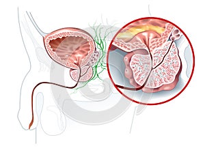 Benign prostatic hyperplasia BPH, enlarged prostate with bladder, urethra and seminal vesicle, medical illustration photo