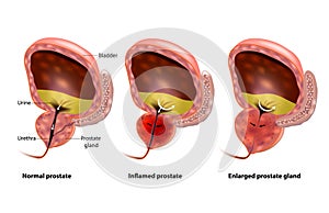 Benign Prostatic hyperplasia photo