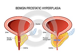 Benign prostatic hyperplasia BPH. prostate enlargement