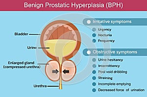 Benign Prostatic Hyperplasia (BPH) , vector
