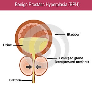 Benign Prostatic Hyperplasia (BPH) , vector