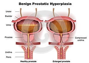 Benign prostatic hyperplasia 3d medical  illustration