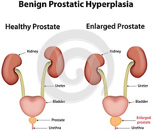 Benign Prostatic Hyperplasia photo