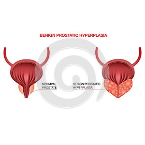 Benign prostatic hyperplasia.Editable vector illustration in realistic style