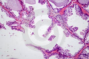 Benign prostatic hyperplasia, light micrograph