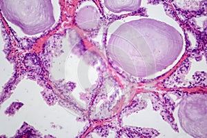 Benign prostatic hyperplasia, light micrograph