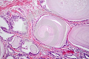 Benign prostatic hyperplasia, light micrograph