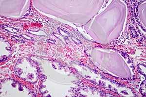 Benign prostatic hyperplasia, light micrograph