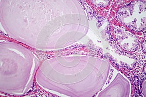 Benign prostatic hyperplasia, light micrograph