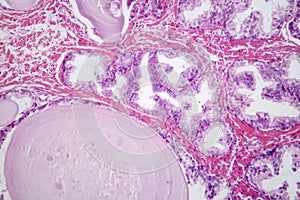 Benign prostatic hyperplasia, light micrograph