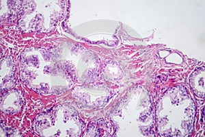 Benign prostatic hyperplasia, light micrograph