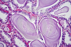 Benign prostatic hyperplasia, light micrograph