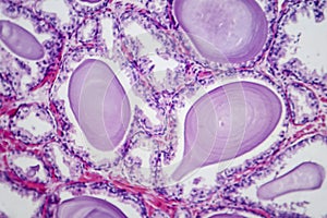 Benign prostatic hyperplasia, light micrograph