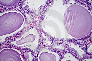 Benign prostatic hyperplasia, light micrograph