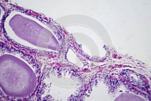 Benign prostatic hyperplasia, light micrograph