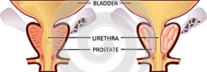 Benign prostatic hyperplasia. prostatitis. vector illustration. Anatomy and health