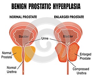 Benign prostatic hyperplasia photo