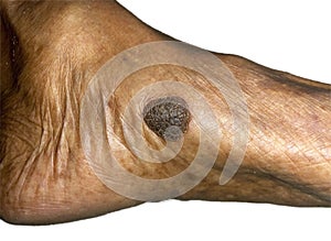 Benign skin growth or single large mole in foot of Asian elder man