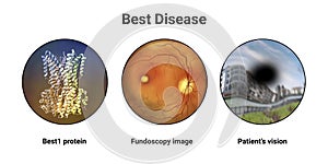 Best disease. Best vitelliform macular dystrophy, illustration