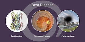 Best disease. Best vitelliform macular dystrophy, illustration photo