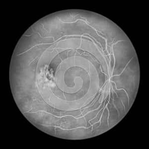Best vitelliform macular dystrophy, Vitelleruptive stage, scrambled egg appearance, illustration, fluorescein photo