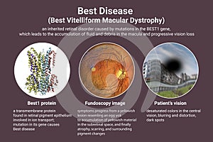 Best vitelliform macular dystrophy, 3D illustration