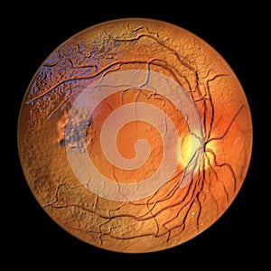 Best vitelliform macular dystrophy, Atrophic stage, retinal atrophy, 3D illustration