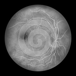 Best vitelliform macular dystrophy, Atrophic stage, retinal atrophy, illustration, fluorescein angiography