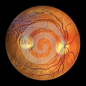 Best vitelliform macular dystrophy, Pseudohypopyon stage, layering of lipofuscin, 3D illustration