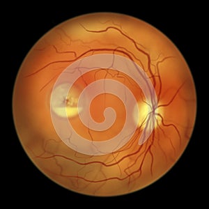 Best vitelliform macular dystrophy, Pseudohypopyon stage, layering of lipofuscin, illustration