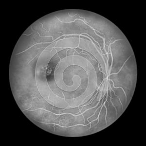 Best vitelliform macular dystrophy, stage 3 Pseudohypopyon, layering of lipofuscin, illustration, fluorescein photo