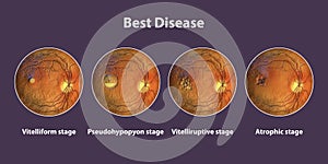 Best vitelliform macular dystrophy stages, scientific illustration