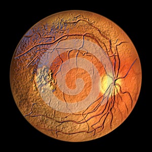 Best vitelliform macular dystrophy, Vitelleruptive stage, scrambled egg appearance, 3D illustration