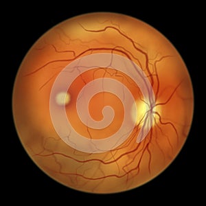 Best vitelliform macular dystrophy, vitelliform stage, classic egg-yolk lesion, illustration