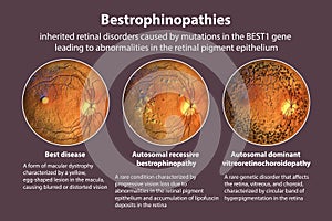 Bestrophinopathies, inherited retinal disorders caused by mutations in the BEST1 gene, 3D illustration photo