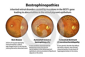 Bestrophinopathies, inherited retinal disorders caused by mutations in the BEST1 gene, illustration photo