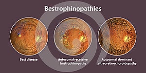 Bestrophinopathies, inherited retinal disorders caused by mutations in the BEST1 gene, illustration photo