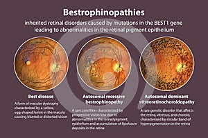 Bestrophinopathies, inherited retinal disorders caused by mutations in the BEST1 gene, 3D illustration