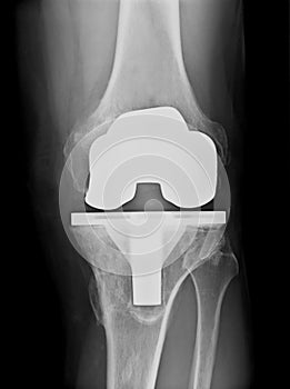 Bicompartmental knee prosthesis xray