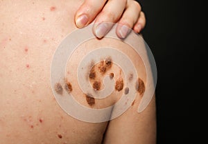 Big birthmarks and freckles on the girl`s skin. Medical health photo of back. Woman`s oily skin with problems acne