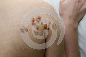 Big birthmarks and freckles on the girl`s skin. Medical health photo of woman`s beck