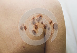 Big birthmarks and freckles on the girl`s skin. Medical health photo of woman`s beck