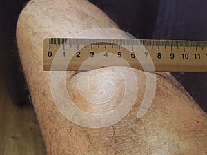 Big lipoma on the leg of a middle aged man