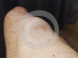 Big lipoma on the leg of a middle aged man