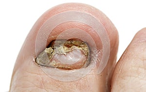 A big nasty toenail fungal disease large